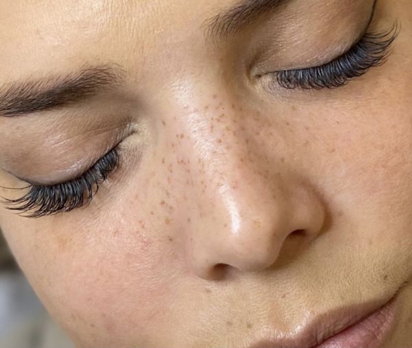 À Dijon | Tâches de rousseur / grain de beauté | Les meilleures esthéticiennes