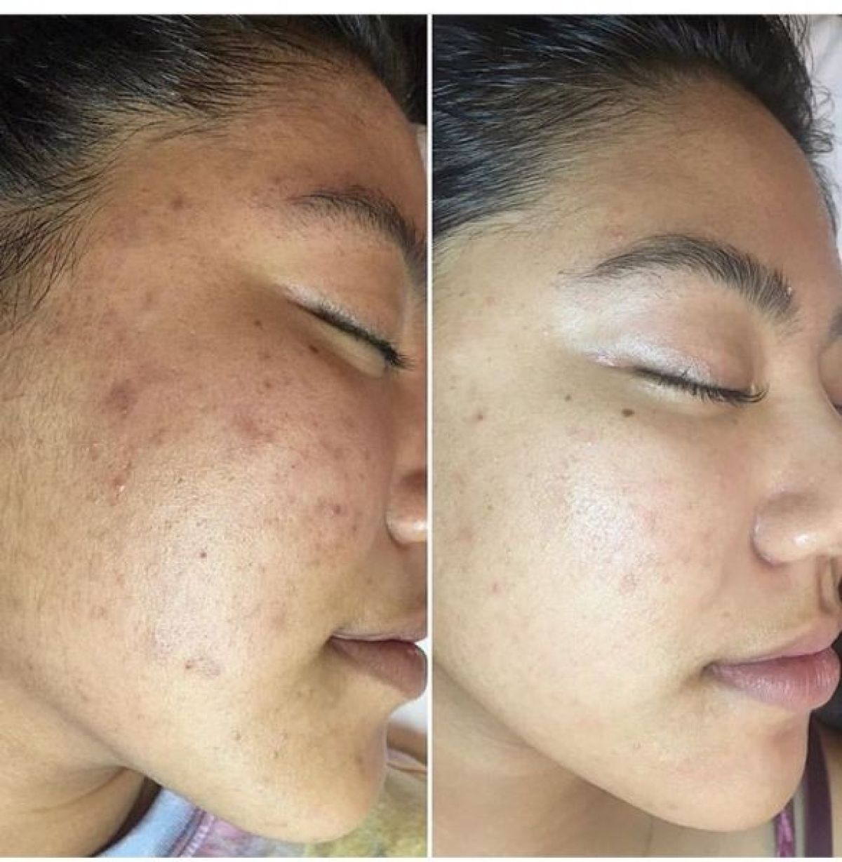Microneedling (contre les vergetures, l'acné...) à Villeneuve-d'Ascq (59) Par Lucie - Estheca
