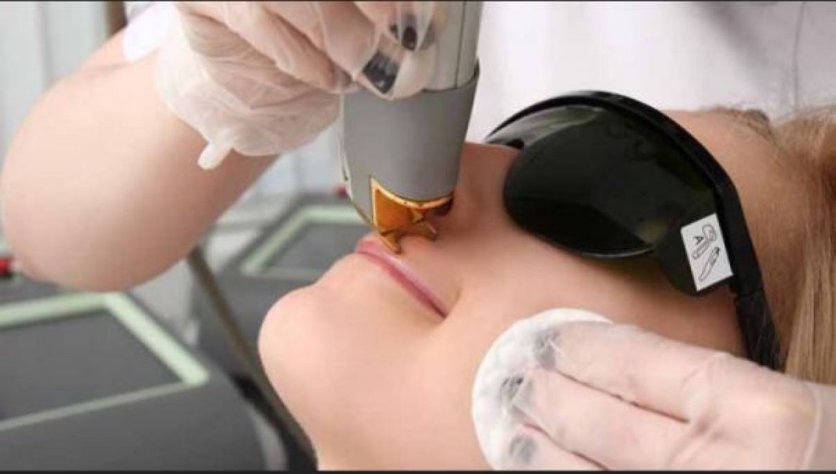 Épilation par lumière pulsée à Tourcoing (59) Par Emy - Estheca