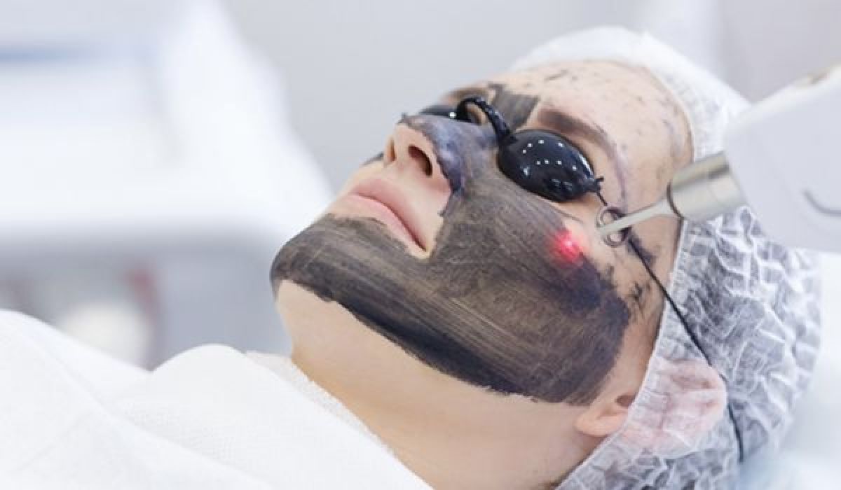 Carbon peel à Reims (51) Par Inès - Estheca