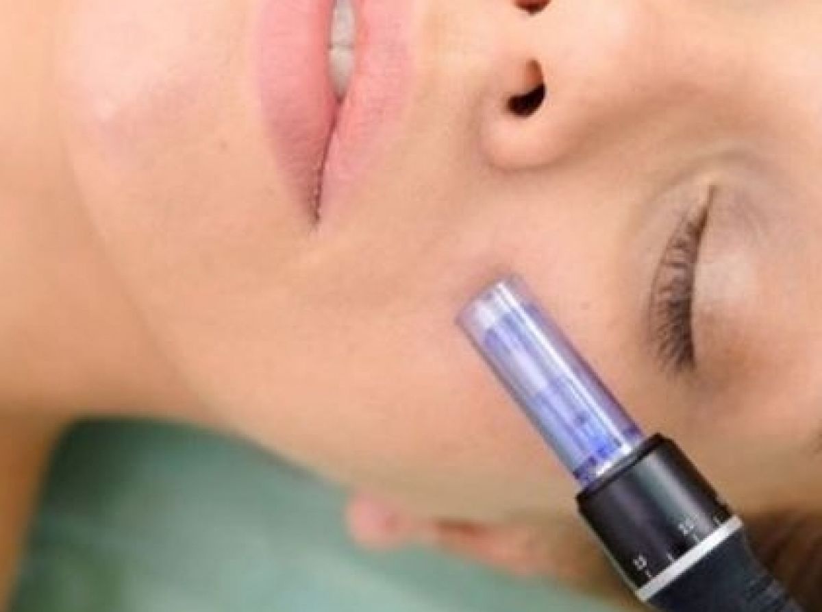 MicroNeedling BB Glow à Uzès (30) Par Angélique - Estheca