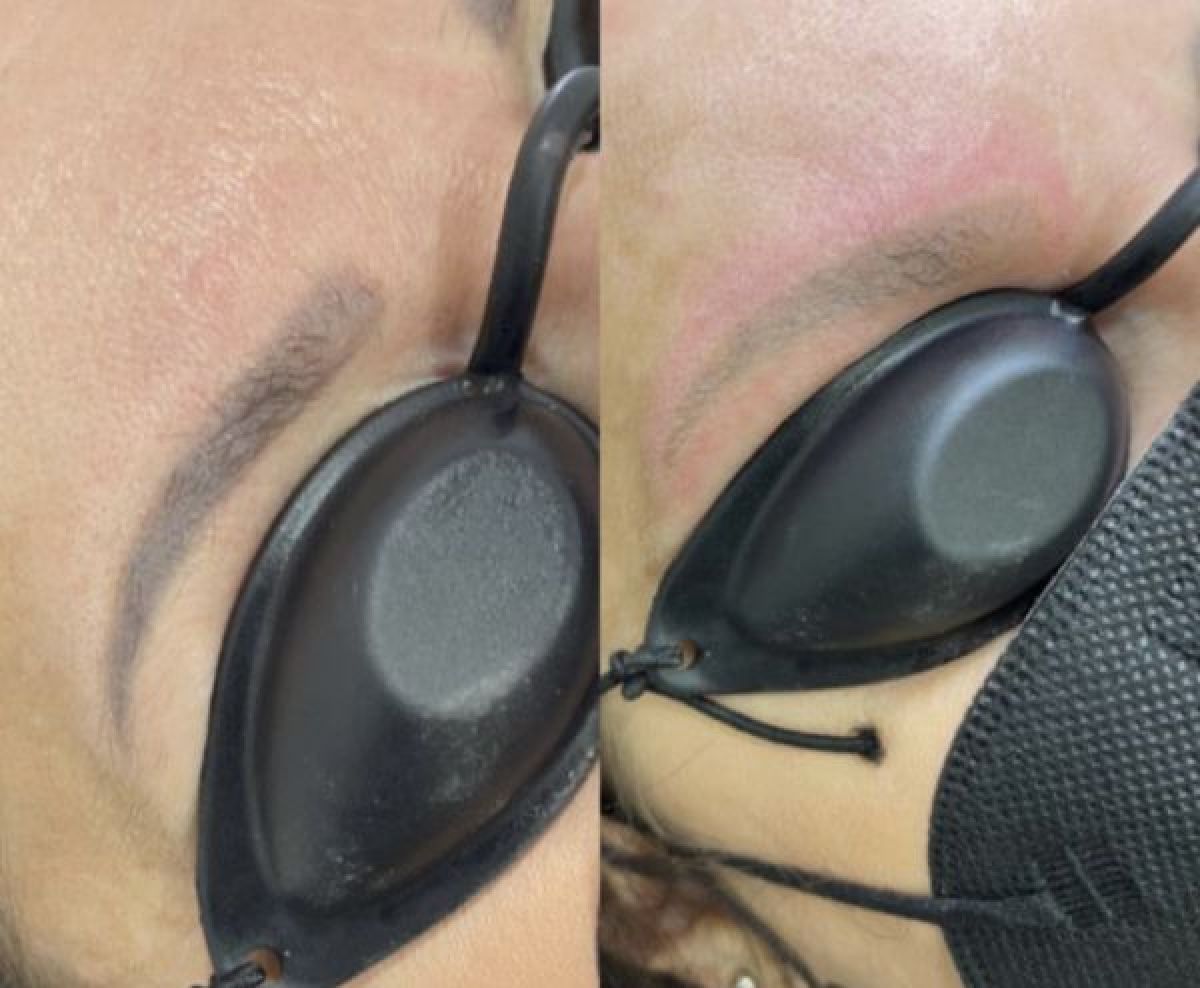 Détatouage laser à Saint-Étienne (42) Par Armine - Estheca