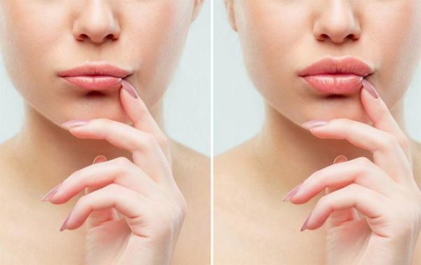 À Châlons-en-Champagne | Radiofréquence lèvres | Les meilleures esthéticiennes