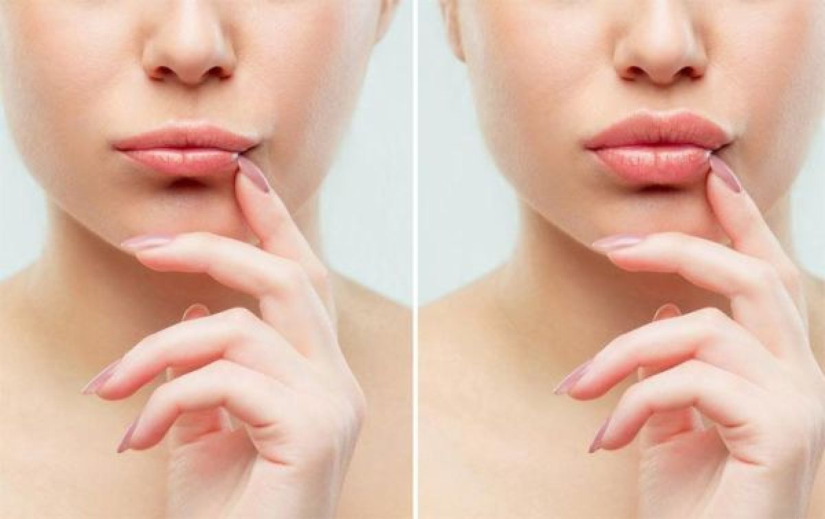 Radiofréquence lèvres à Châlons-en-Champagne (51) Par Vanessa - Estheca