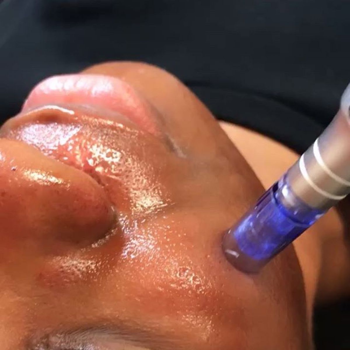 MicroNeedling BB Glow à Choisy-le-Roi (94) Par Clémence - Estheca