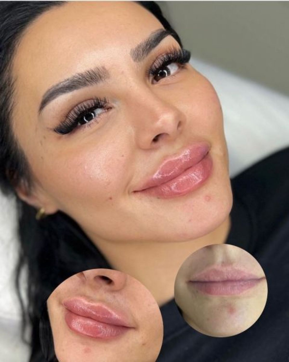 Augmentation volume des lèvres  à Meaux (77) Par Lilya - Estheca