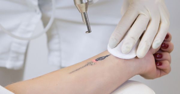 À Antony | Detatouage laser | Les meilleures esthéticiennes