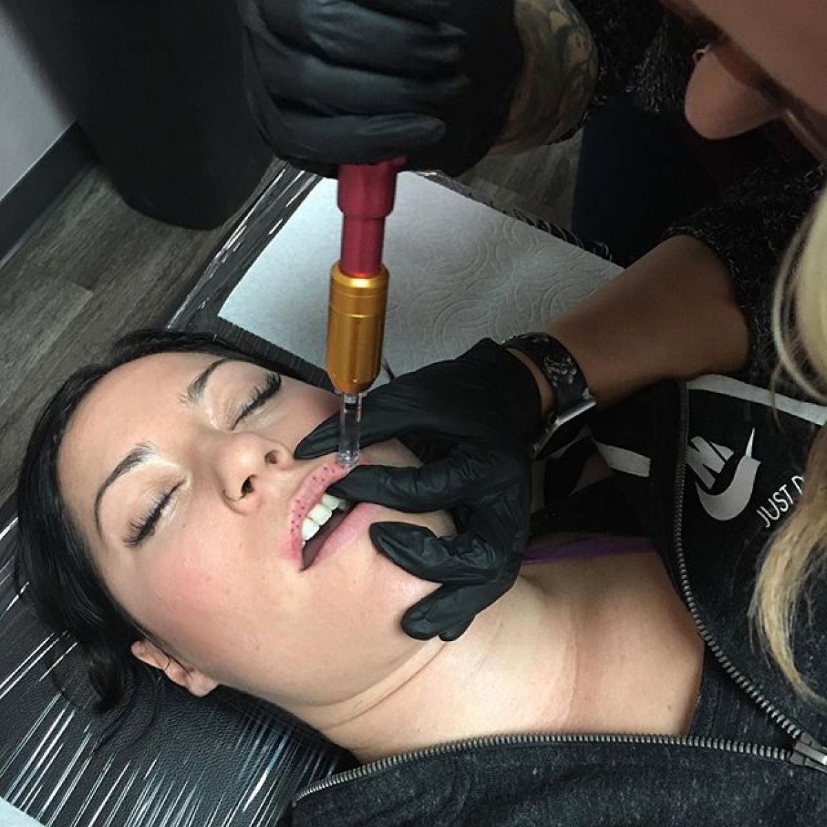 Hyaluron pen lèvres et rides à Massy (91) Par Chloé - Estheca