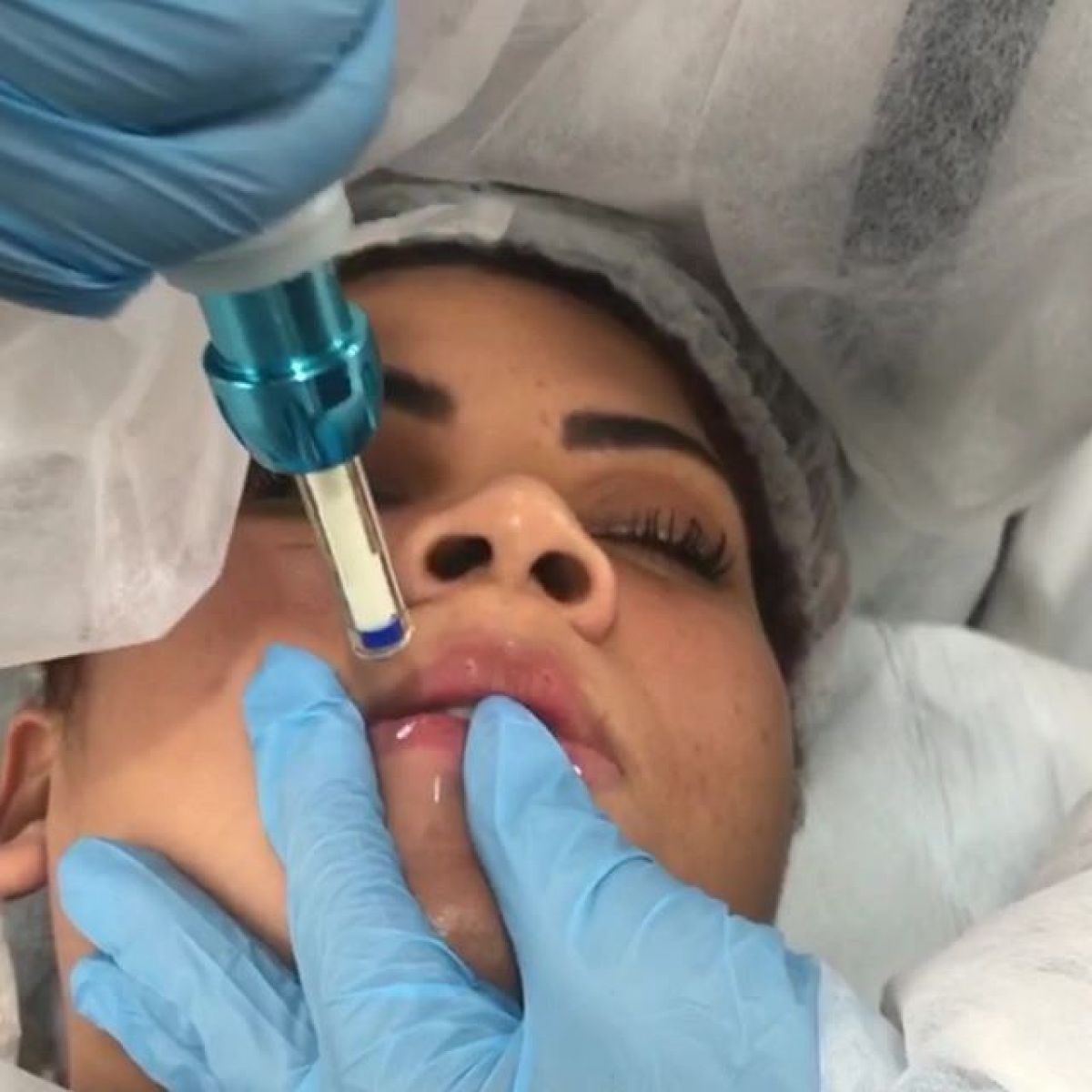 Hyaluron pen lèvres et rides à Champigny-sur-Marne (94) Par Mélody - Estheca