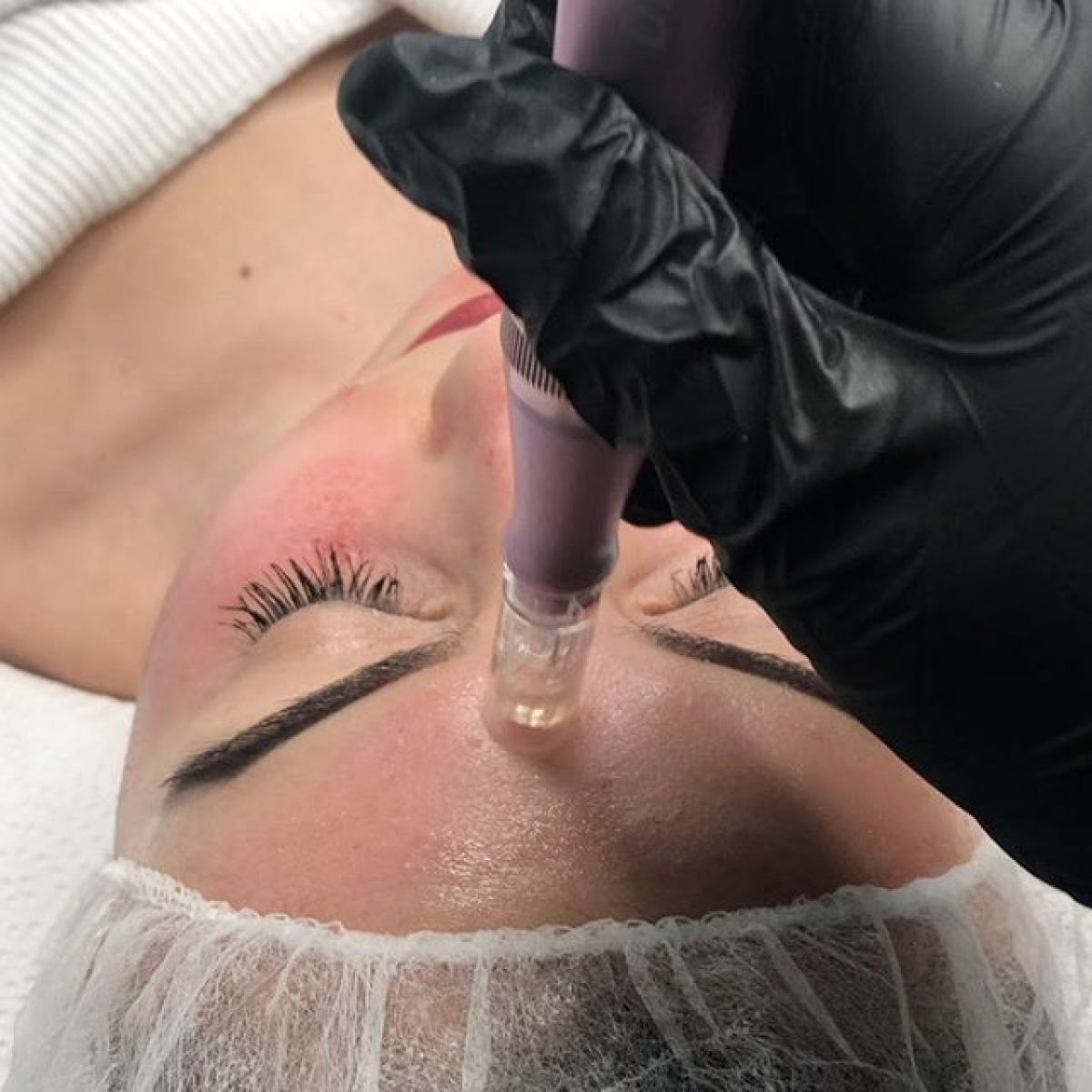 MicroNeedling BB Glow à Hœnheim (67) Par Marie - Estheca