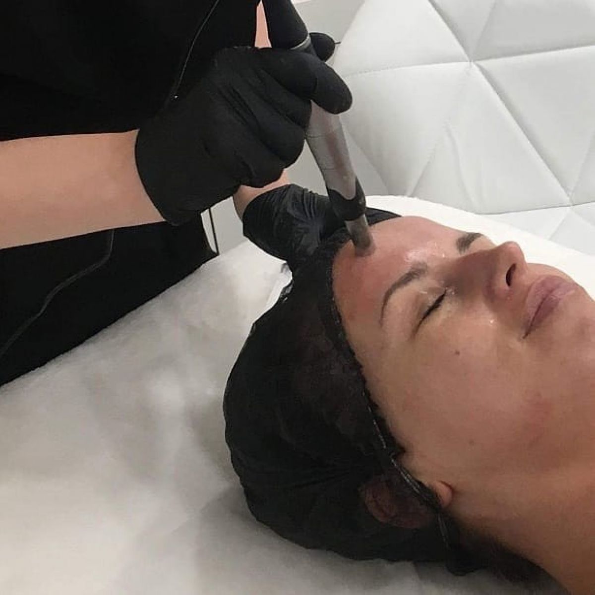 MicroNeedling BB Glow à Vandoeuvre-lès-Nancy (54) Par Camille - Estheca