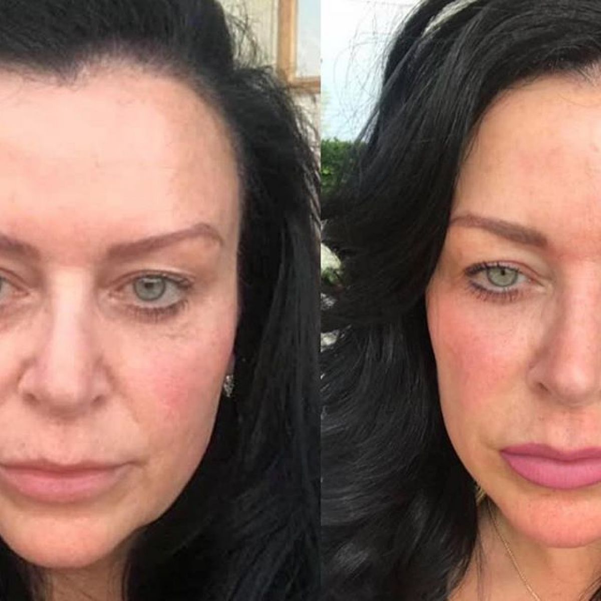 MicroNeedling BB Glow à Versailles (78) Par Virginie - Estheca