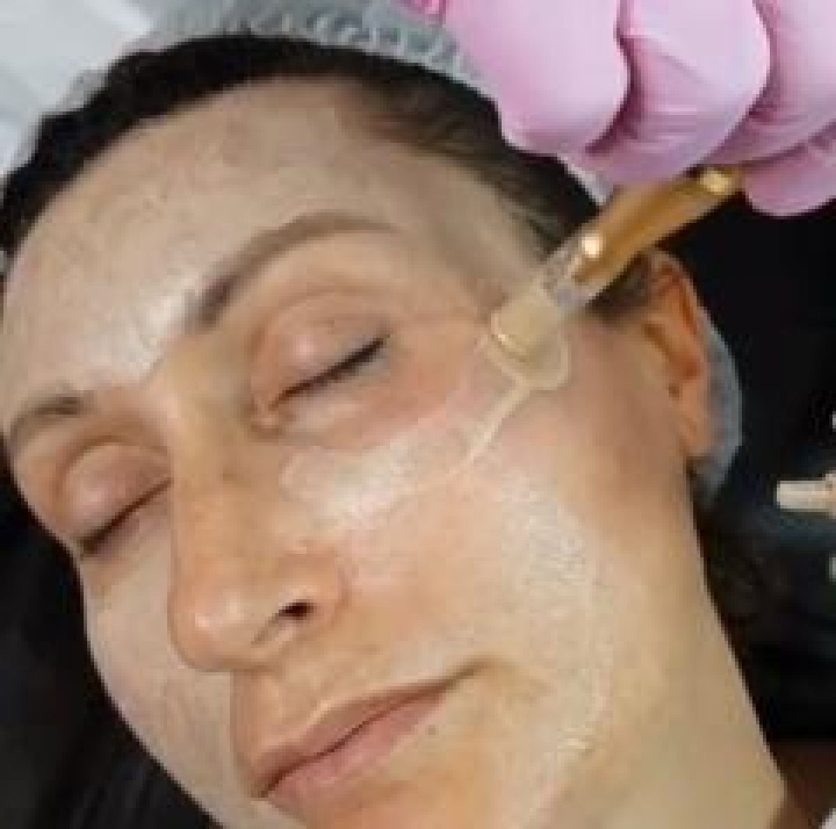 MicroNeedling BB Glow à Erstein (67) Par Margot - Estheca
