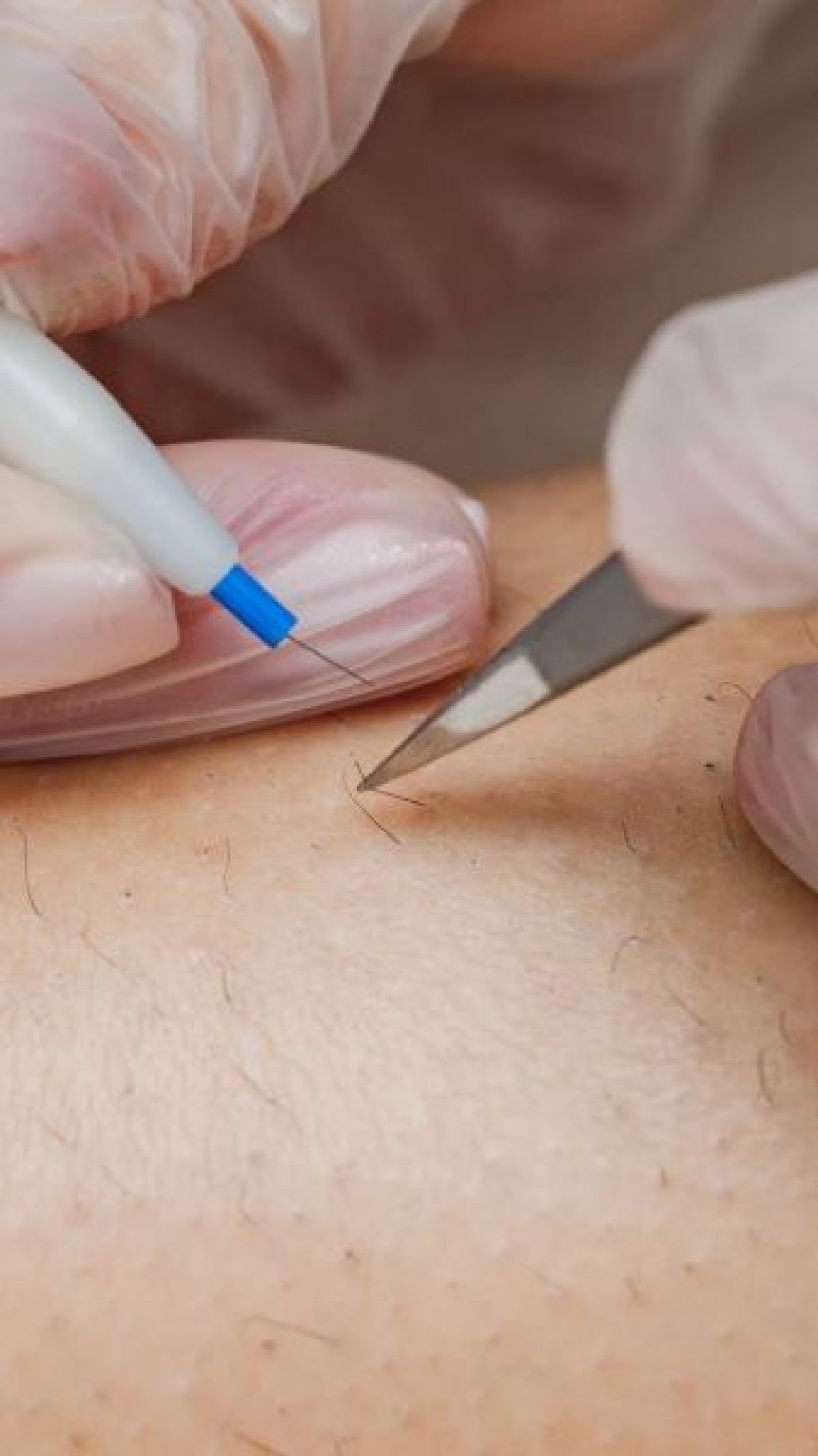 Électrolyse à Villeurbanne (69) Par Zahidé - Estheca